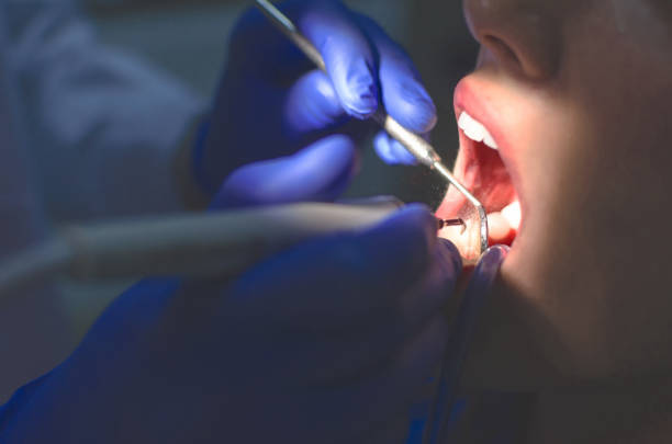 tooth extraction