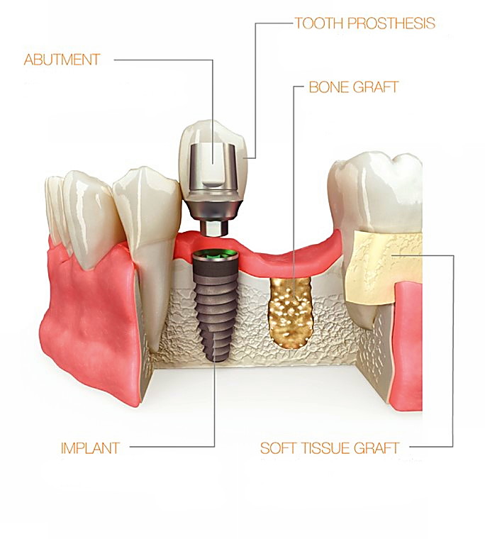 implants guidance