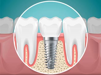 implants home