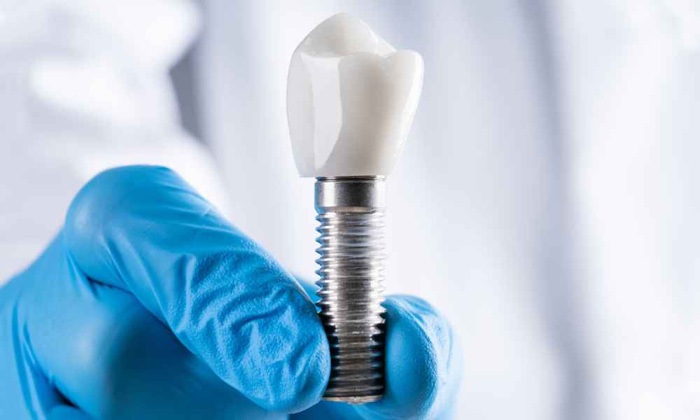 5 Signs You Might Need a Dental Implant