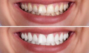 Teeth Whitening: How to Get a Brighter Smile Safely
