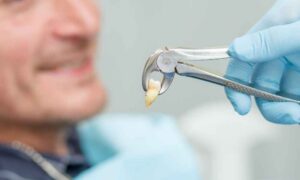 What to Expect During a Tooth Extraction