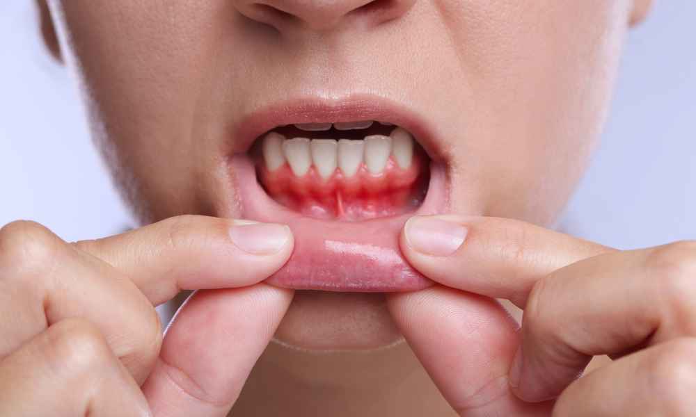 How to Recognise the Early Signs of Gum Disease